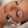 Microneedling dermaroller